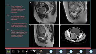 Carcinosarcoma Cérvico Uterino [upl. by Hoisch]