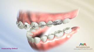 Orthodontic Treatment for Overjet Overbite  Wilson Bimetric Distalizing Arch Appliance [upl. by Ahsrav]