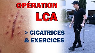 OPÉRATION LCA Ép 4  exercices cicatrices glaçage [upl. by Pepin993]