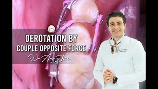 orthodontic derotation of rotated premolar by amr asker [upl. by Eiznil76]