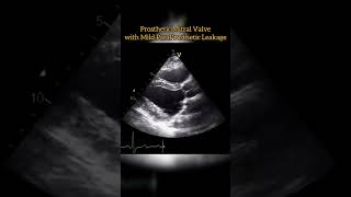 Prosthetic Mitral Valve echocardiogram echo Echocardiography For Beginners [upl. by Odrareve]