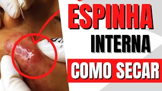 4 DICAS de COMO SECAR ESPINHA INTERNA Acne NóduloCística [upl. by Channing648]