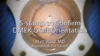 DMEK S Stamp to Confirm Graft Orientation [upl. by Jonie582]