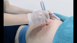 Stretch Mark removal using Microneedling [upl. by Ree]