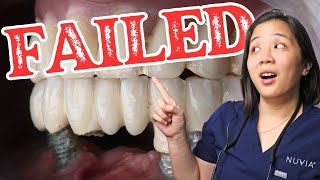 Doctor Reveals Top 3 Reasons Dental Implants Fail [upl. by Oby]