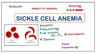 Sickle Cell Anemia  Causes PathophysiologySymptoms Lab Diagnosis amp Treatment pathology robbins [upl. by Humpage]