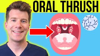 Doctor explains ORAL THRUSH Oral Candidiasis  Symptoms treatment amp prevention in adultsbabies [upl. by Rodmun42]