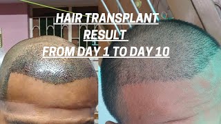 Hair transplant result from Day 1 to Day 10 [upl. by Leanor809]