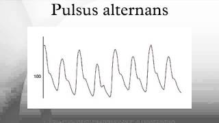 Pulsus alternans [upl. by Euqinad]