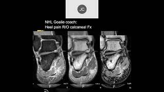 MRI of the Ankle Part 12 – Ankle Impingement [upl. by Harriman]