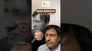 Mole Removal in Just 1 Session Is Now Possible  Dr Deepam Shah [upl. by Ahseem434]