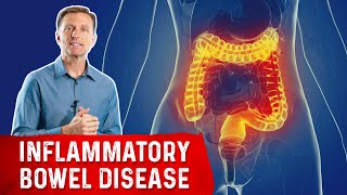 The Most Common Nutrient Deficiency in IBD Inflammatory Bowel Disease [upl. by Darken]