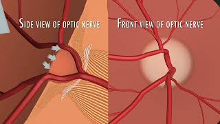 What are the nerve fibers as it relates to glaucoma [upl. by Aiuqenehs]