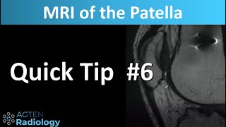 MRI of the Patella The Patellar Calcar [upl. by Thapa]