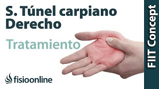 Tratamiento del síndrome de túnel carpiano derecho [upl. by Craner793]