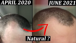 1 Year Receding Hairline Regrowth Naturally Update  How To Stop Receding Hairline And Regrow Hair [upl. by Palestine399]