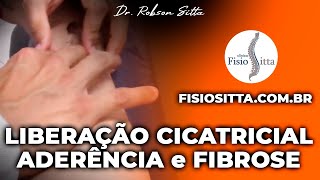 MASSAGEM de LIBERAÇÃO CICATRICIAL PREVENÇÃO ADERÊNCIA FIBROSE Clínica Fisioterapia Dr Robson Sitta [upl. by Swetlana82]