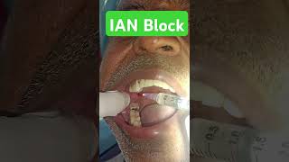 Inferior Alveolar Nerve Block Demonstration on Patient dentistry dentist smile [upl. by Gabrielson790]