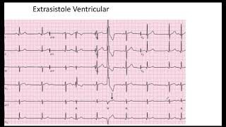 Extrasistole Auricular y Ventricular EKG [upl. by Nagar]