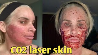 7Day Journey My CO2 Laser Skin Resurfacing Experience – Before and after chris link [upl. by Clements]