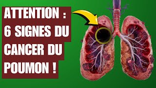 Détectez les 6 Signes de Cancer du Poumon AVANT quil Ne Soit Trop Tard  🚨👀 Santé Cancer [upl. by Kobylak]