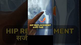 How Hip Joint Replaced कूल्हा बदल गया hipreplacementrecovery hipfracture hippain bone [upl. by Braun786]