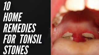 10 Home Remedies For Tonsil Stones That Work Fast  How To Get Rid of Tonsil Stones at Home [upl. by Anjanette]