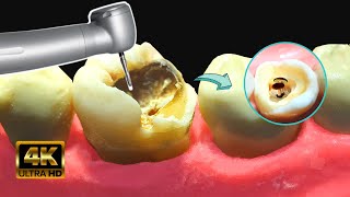 Caries GIGANTE con HONGOS en 4k  Tratamiento de conducto [upl. by Quillan383]