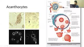 APPROACH TO NEPHRITIC AND NEPHROTIC SYNDROMES  DR JAYAPRAKASH THANGAVEL NEPHROLOGY [upl. by Warfeld248]