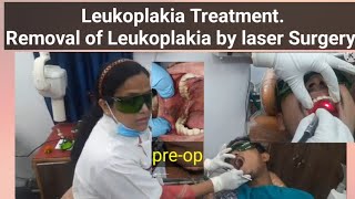 Leukoplakia TreatmentRemoval of Leukoplakia by laser Surgery [upl. by Nylsoj313]