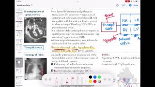 Tricuspid Atresia congenitalheartdisease cardiology 55 First Aid USMLE Step 1 in UrduHindi [upl. by Aicetel]