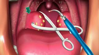 Animation Surgery of Tonsillectomy amp Adenoids [upl. by Toffic177]