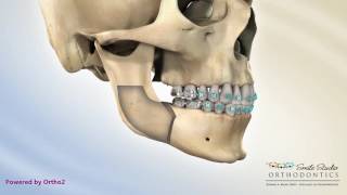 BSSO Mandibular Setback  Transcortical [upl. by Ayeki]