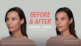 A Smooth Contour In The Jawline With JUVÉDERM® Filler  Lara’s Before amp After [upl. by Akenahs189]