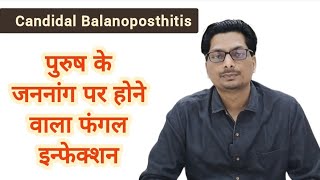 Candidal Balanoposthitis  पुरुष के अंग पर होने वाला फंगल इन्फेक्शन  Fungal infection candida [upl. by Kaz]