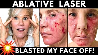 Skin LASER RESURFACING My One Year Recovery Journey Week by Week [upl. by Armbrecht]