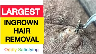 Largest Ingrown Hair Removal  Oddly Satisfying Hair Extraction [upl. by Nnaeinahpets]