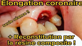 Élongation coronaire et reconstitution en une seule séance ‼️ [upl. by Utir]