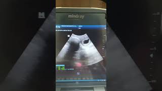 Blighted ovum Ultrasound ultrasound shortvideo [upl. by Calv429]