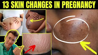 Doctor explains 13 SKIN SIGNS AND CHANGES SEEN IN PREGNANCY plus real life clinical photos [upl. by Pohsib]