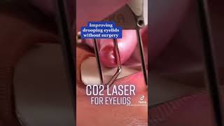 How to Rejuvenate Your Eyes  CO2 Laser Treatment [upl. by Tosch445]