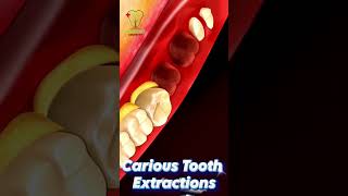 Immediate Implant Placement After Tooth Extraction [upl. by Arec]