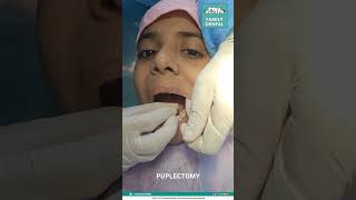 Pulpectomy FamilyDentalMoulali [upl. by Dolli]