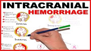 Intracranial Hemorrhage EpiduralSubduralSubarachnoid overview [upl. by Ellerahc]