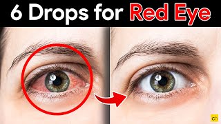 Fast and Effective 6 Eye Drops to Cure Red Eyes  Credihealth [upl. by Eira]