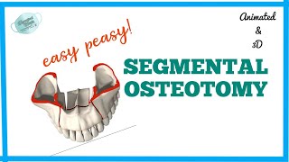 SEGMENTAL OSTEOTOMY  MAXILLARY OSTEOTOMY [upl. by Atsilac]