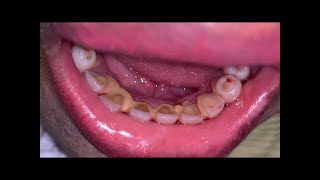 Deep Cleaning With HEAVY Tartar Build Up At The Dentist [upl. by Lachance]