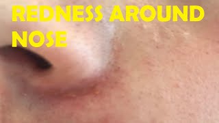 how to get rid of redness around nose [upl. by Elleivap757]