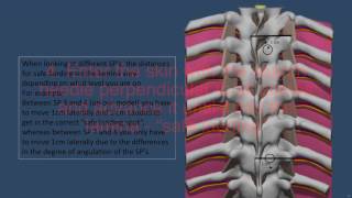 Landmark Based Thoracic Epidural [upl. by Burtie]