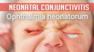 Conjunctiva  purulent conjunctivitis  Ophthalmia neonatorum Part 3 [upl. by Zalea214]